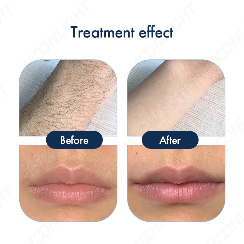 ND-YAGDiode-laser-D210 ND-YAGDiode-laser-D210