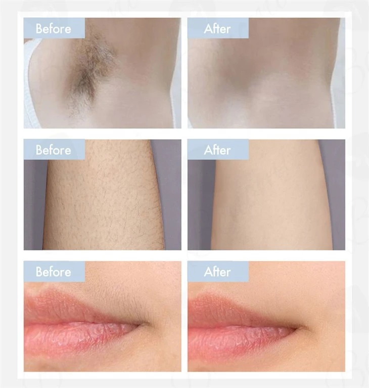 2024 Manufacturer Price Diode Laser Hair Removal Machine