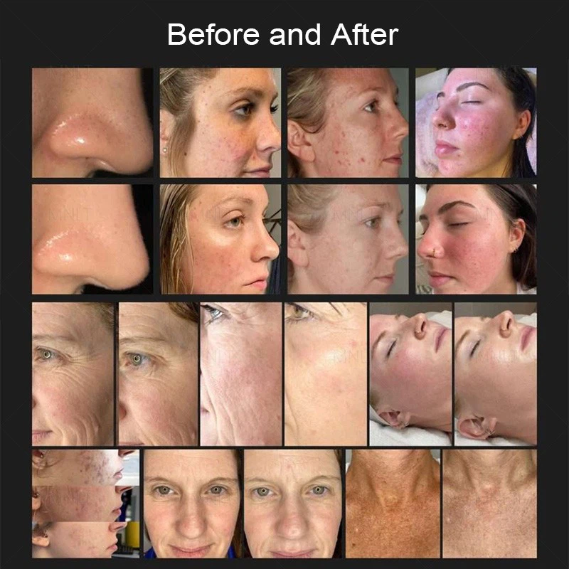 2026 NEW Cold Plasma Skin Rejuvenation System manufacturers